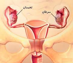 سرطان تخمدان یک سرطان فامیلی جدی در زنان