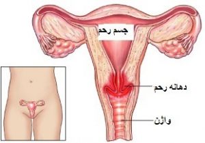 عفونت قارچی واژن طبق نظر بهترین متخصص زنان در شیراز چیست؟