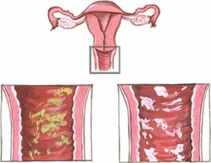 علت ترشحات واژن چیست؟ | نظر جراح و متخصص زنان در شیراز
