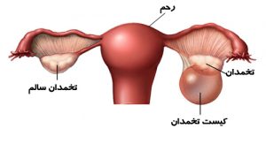 علت ایجاد کیست تخمدان چیست؟ | نظر متخصص زنان در شیراز