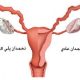 تخمدان پلی کیستیک به گفته جراح و متخصص زنان در شیراز چیست؟