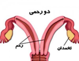 دو رحمی بودن زنان طبق نظر جراح و متخصص زنان در شیراز