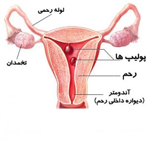 پولیپ رحمی به گفته جراح و متخصص زنان در شیراز