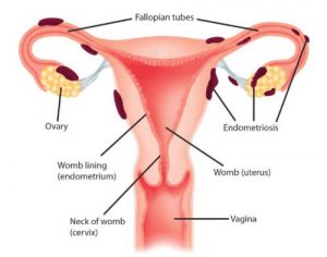 آندومتریوز و بارداری