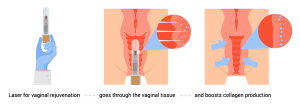 جوانسازی واژن بدون جراحی با استفاده از لیزر
